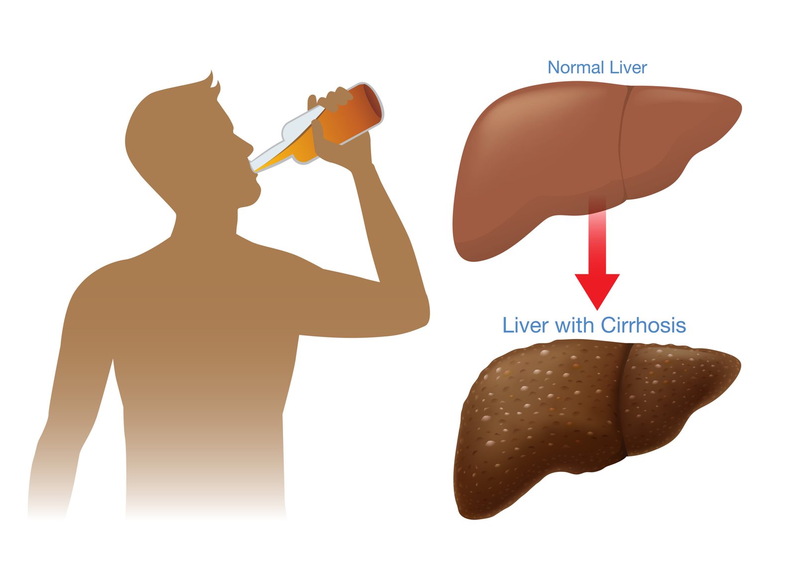 Alcoholic Liver Disease